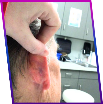 DermTology™ after photo of the back of the ear