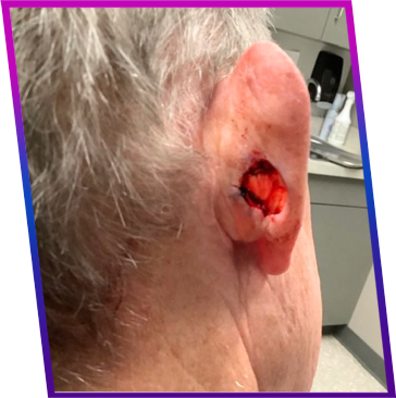 DermTology™ before photo of the back of an ear